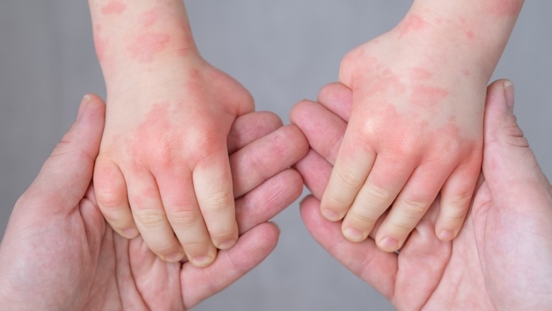 Effective Management of Atopic Dermatitis Symptoms and Treatment